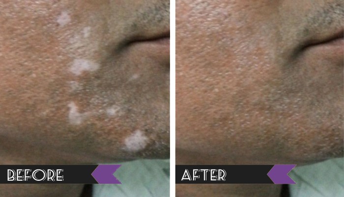 Vitiligo treatment before and after — chin and cheek patches
