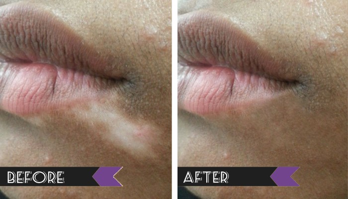 Vitiligo treatment before and after — lip area