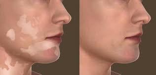 Vitiligo treatment before and after — neck and jaw repigmented
