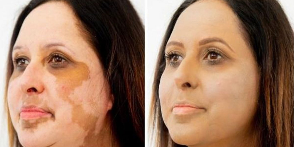 Vitiligo treatment before and after — facial pigmentation restored