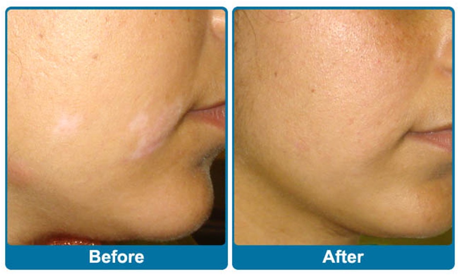 Vitiligo treatment before and after — small lip-side patch cleared